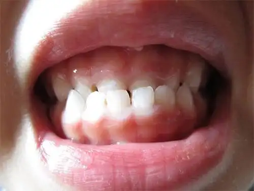 儿童地包天最佳矫正时间