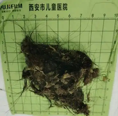 慎入西安11岁女孩从小不断吃头发结果胃长出大石头