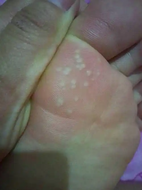 我脚底有好多白色点点弄破里面也没有水还是跟外表一样请问那是什么?