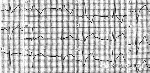 第七章缓慢性心律失常的心电图诊断