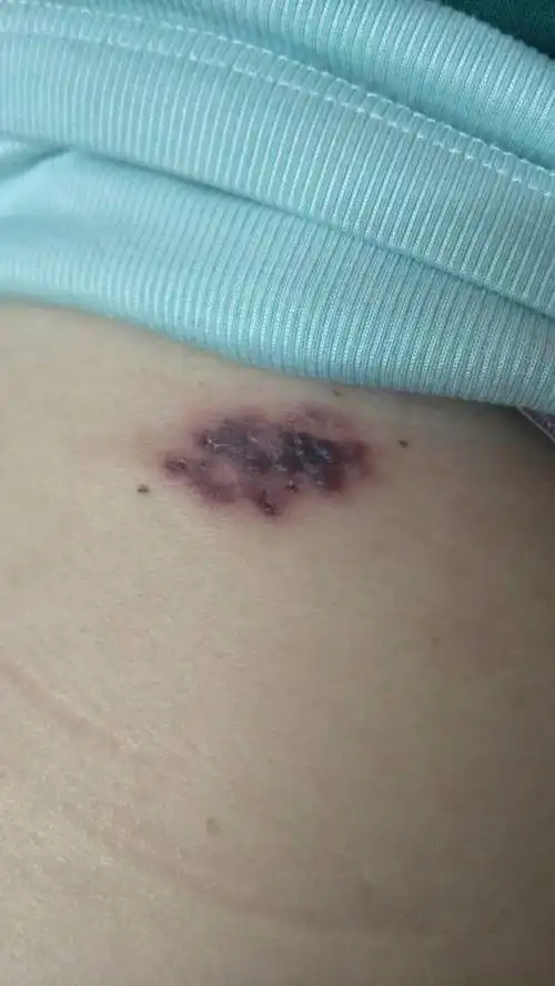 飞蛇皮肤病,飞蛇疮,带状疱疹,是这个吗.