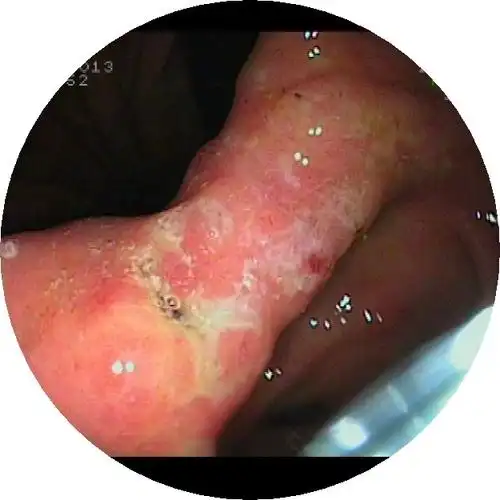 胃角早癌一例,本病人是因为腰痛长期口服止痛药常规