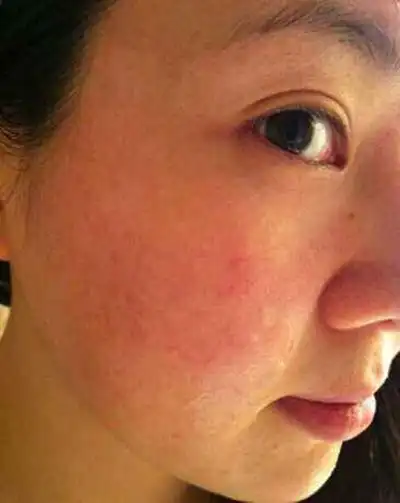 脸部过敏图片 (44)_有来医生