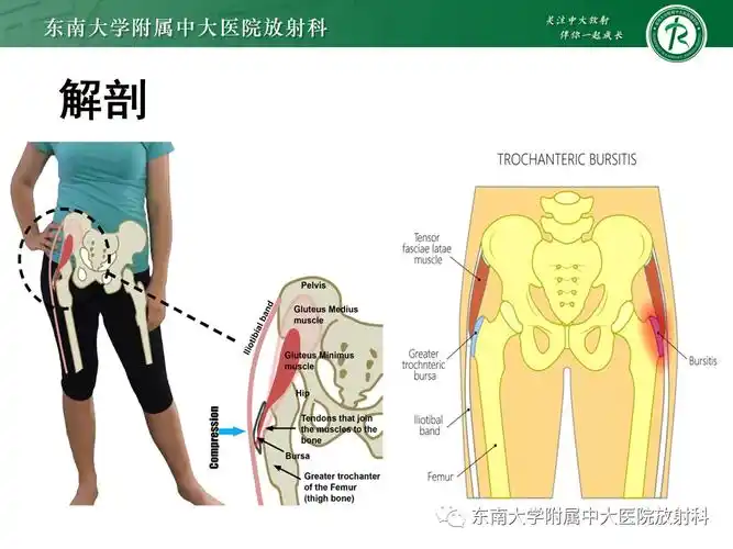 『8分钟创伤』股骨大转子疼痛综合征(gtps)
