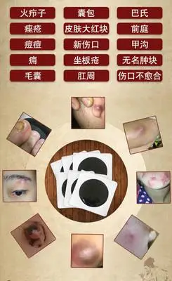 闷头疖子屁股硬块拔毒坐板疮拔脓拔毒膏浓疮包毛囊吸脓贴护膝