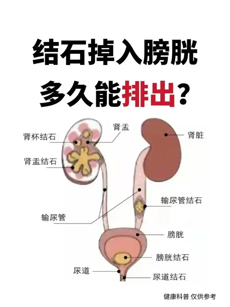 结石掉入膀胱,多久能够排出?#结石 #尿路结石 #肾结石  - 抖音