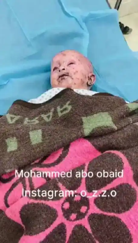 以色列要求古特雷斯辞职#一个被以军炸得遍体鳞伤的巴勒斯坦婴儿