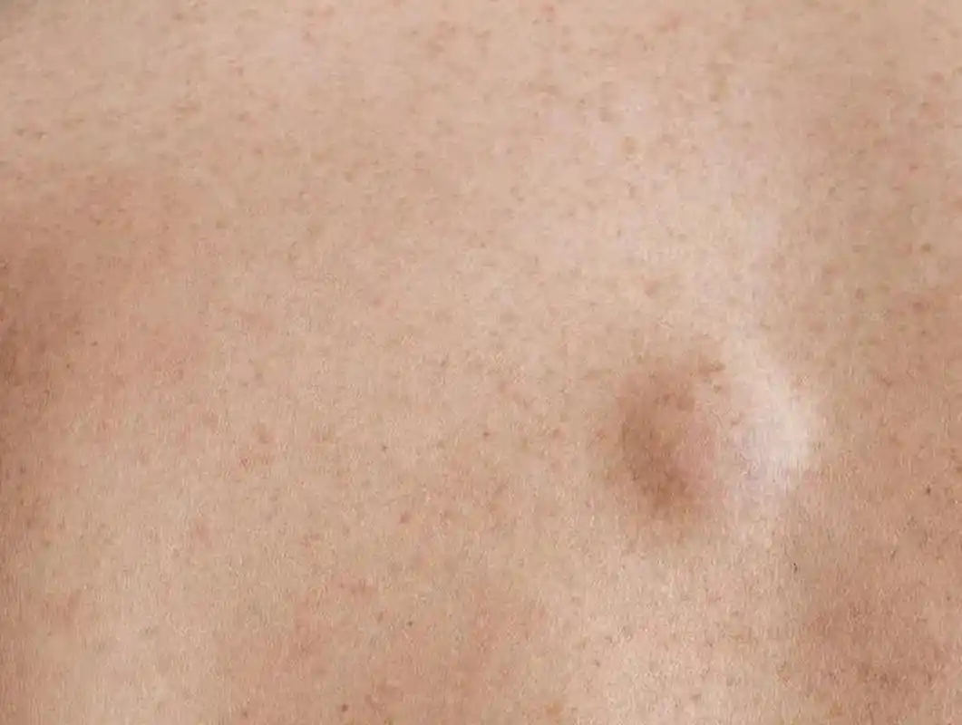 小赵今年26,突然发现后背长了个包,到社区医院,医生