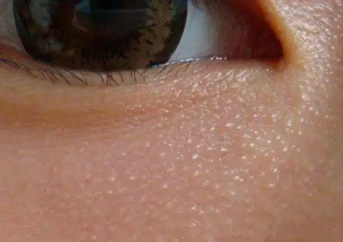 宝宝脸上长脂肪粒图片