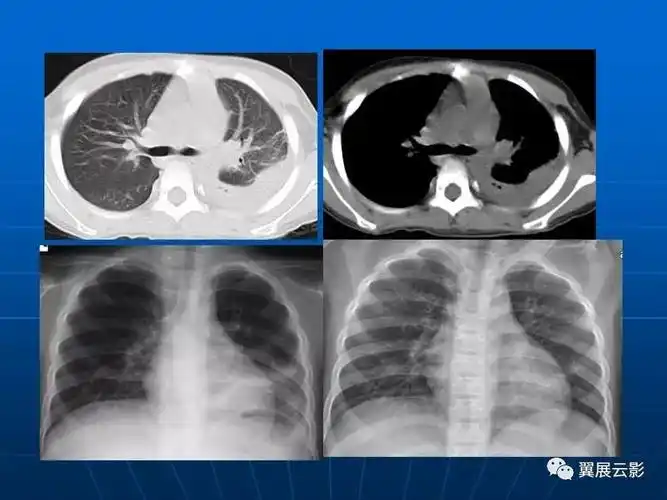 肺部炎症新认识