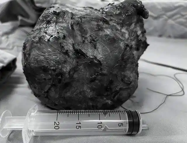 看两个睾丸的大小或重量是否明显不同,睾丸是否有异常肿大及硬块等