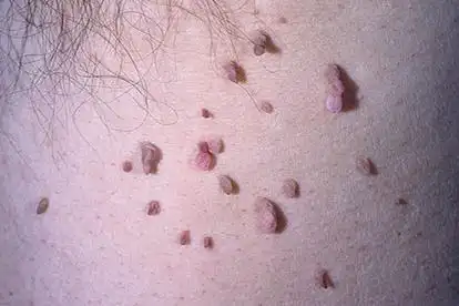 腋下人乳头瘤病毒照片