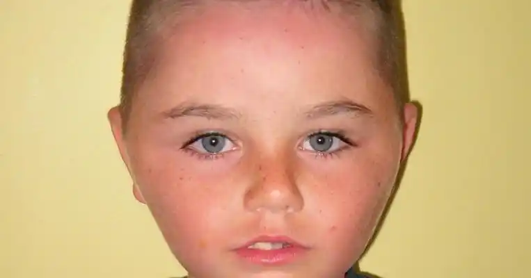 腮腺炎的症状和图片 (22)