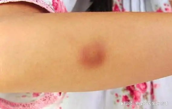 不要忽视身上长出的疙瘩可能是癌症的预兆