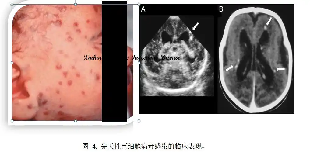 生命早期的人巨细胞病毒感染(一)