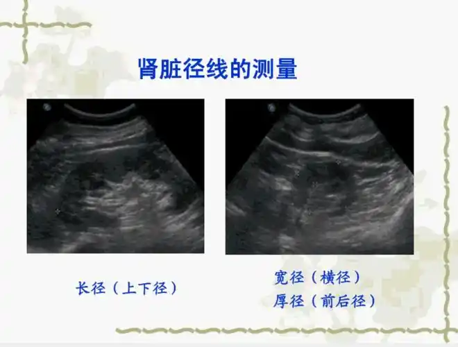 正常肾脏的超声诊断