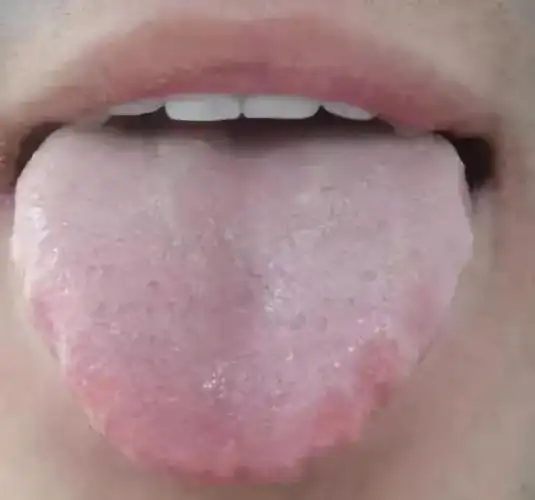 舌有齿痕就是湿气重?中医专家表示,肝郁湿热也会导致齿痕舌