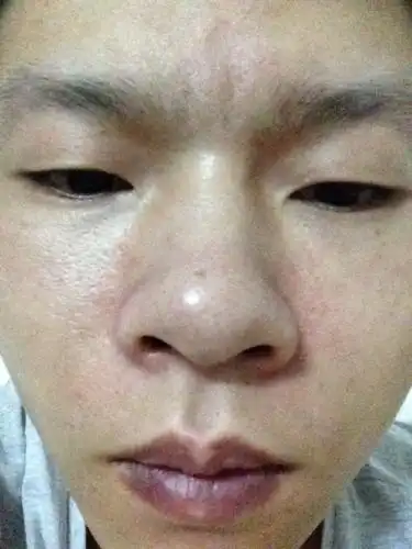 请问我鼻子两侧总是脱皮还带点搔痒是怎么回