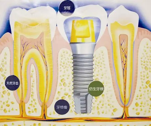 牙齿打桩疼吗_牙齿打桩种植好不好