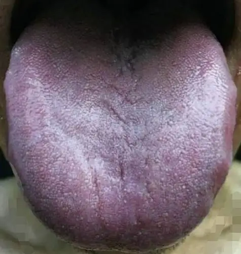 这样的舌头就要警惕癌症!