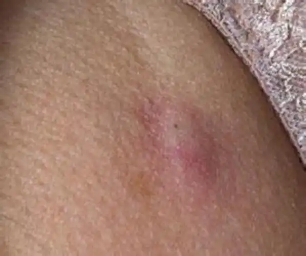 腋窝淋巴结肿大症状有哪些_有来医生