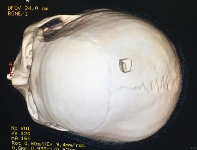 危险的骨片——记一则顶骨凹陷性骨折病例