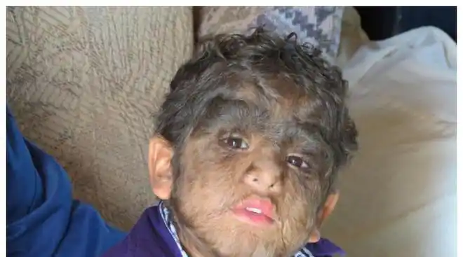 家族里大约有30个人患有先天性多毛症,因为他们身上