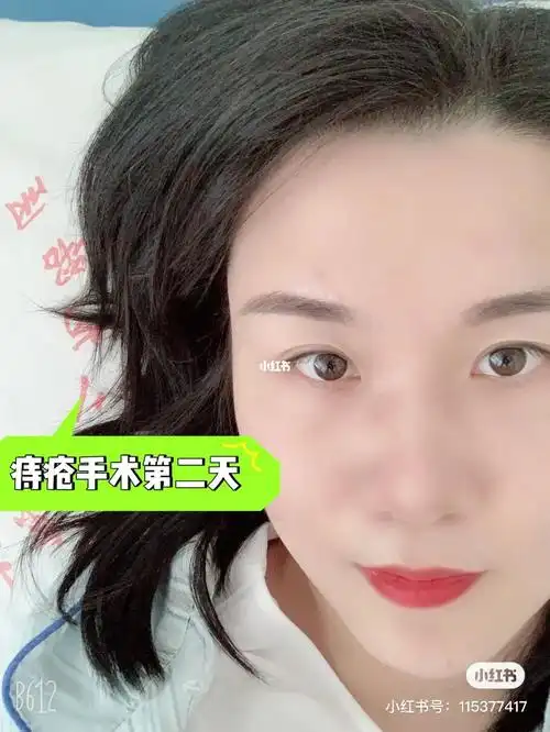 痔疮混合痔手术第二天