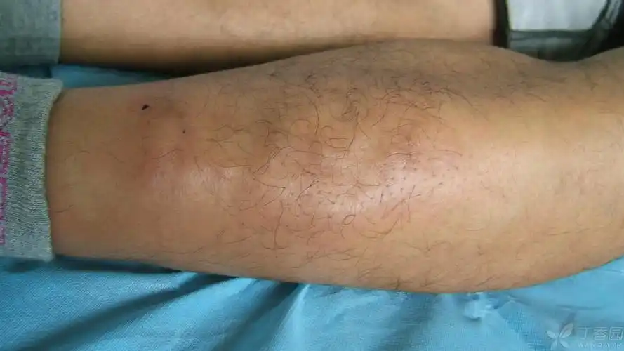 【请教】一侧小腿结节,考虑什么