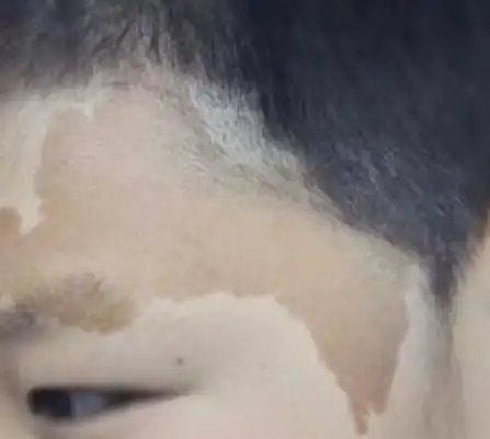 牛奶咖啡斑的图片