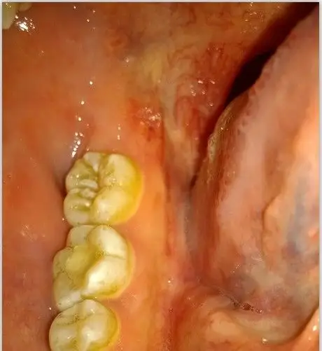 后面的 牙龈红肿.疼. 能怎么消炎吗