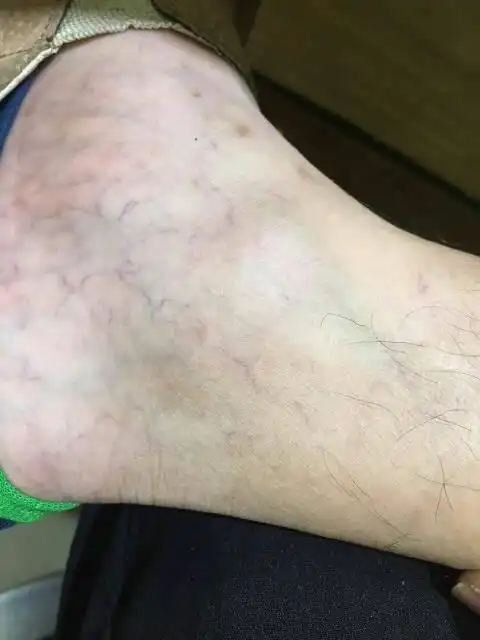 谁知道脚上血管这样子正不正常?