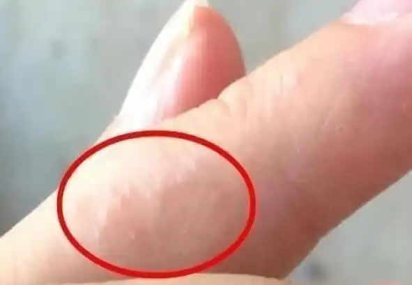 手上这种透明小水泡以为是上火那是身体发出的求救信号