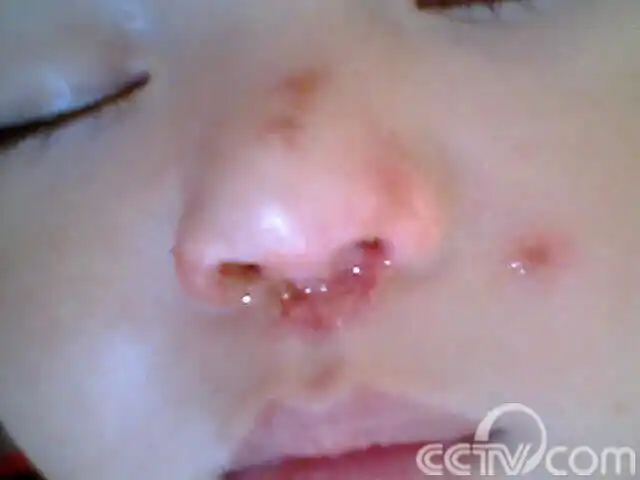 问:宝宝三个月大这几天发现鼻子烂了,有黄色的结疤老是不好怎么回事?