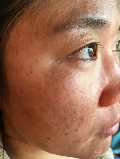 各位同仁,黄褐斑如何正规治疗,方法求教