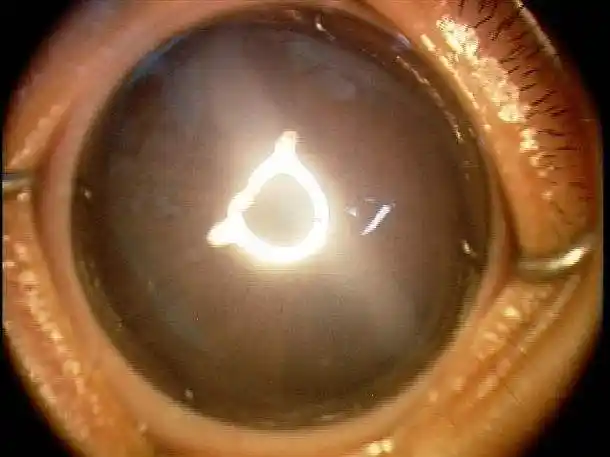 什么原因引起婴幼儿型青光眼?