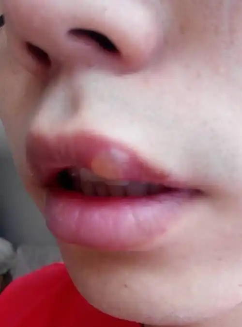 嘴唇上长了个大水泡,应该是口腔生疮吧,谁知道怎么处理好的快些,水泡