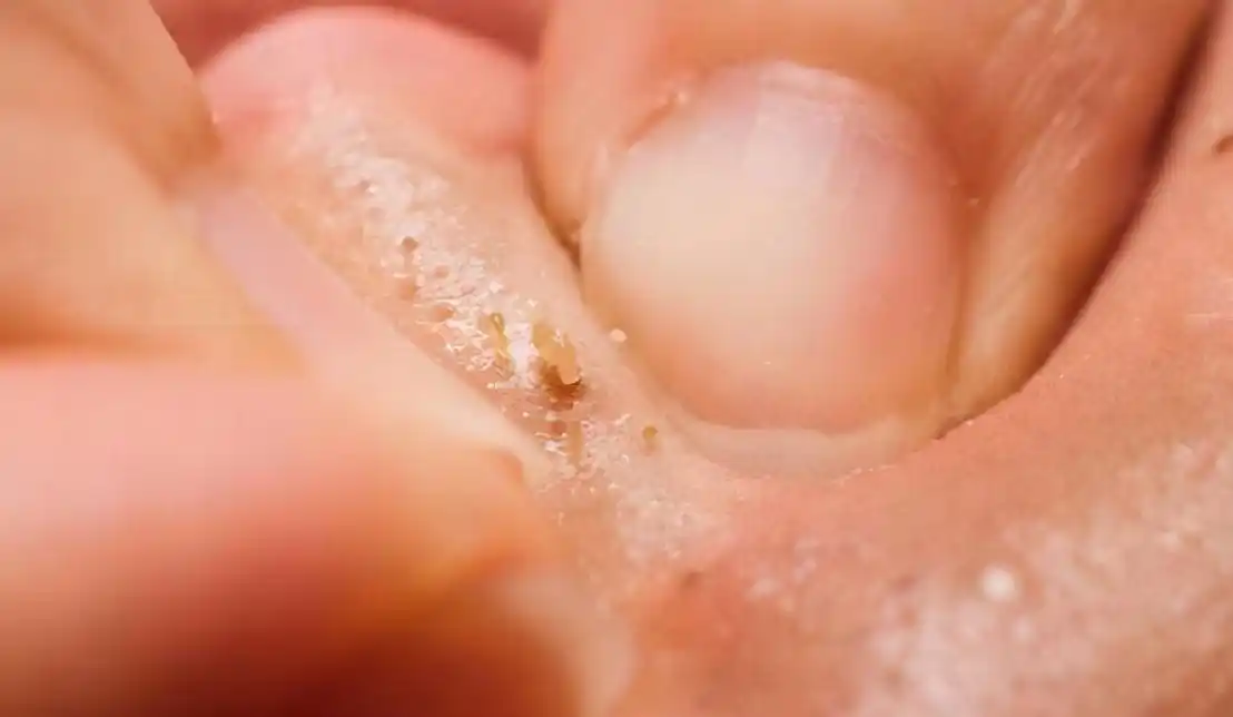 鼻子两翼挤出白色分泌物,可能不是粉刺而是螨虫,很多人还不知情