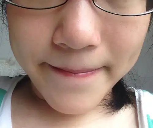 问:我的鼻头很圆很大请问该如何治疗?