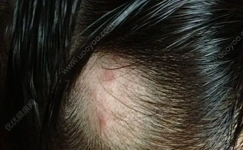 毛孔会处于张开状态,用来排出汗液,当豆皮不够清洁的时候,例如头皮屑