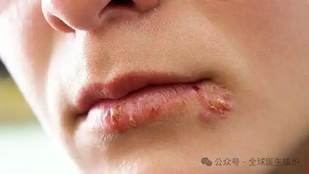 惊讶!口腔单纯疱疹病毒感染后患痴呆症风险增加两倍