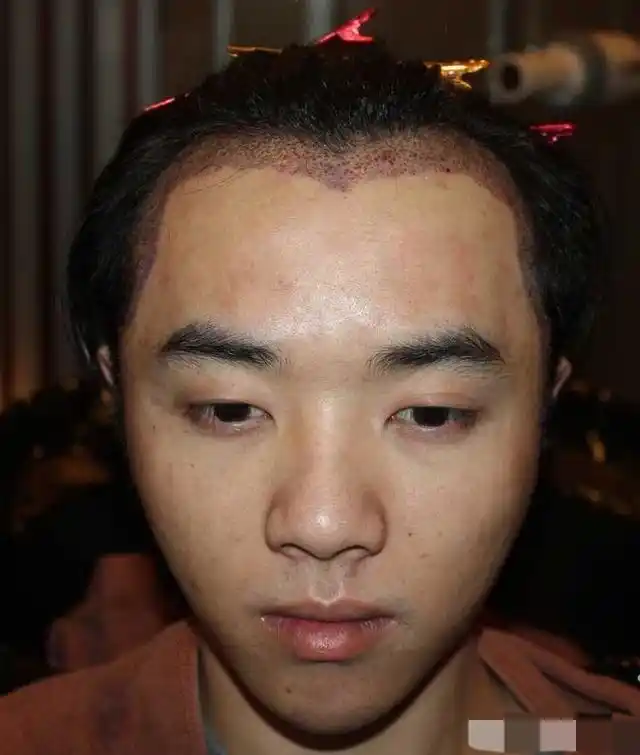 华晨宇最新素颜照曝光!满脸痘印,发际线超高