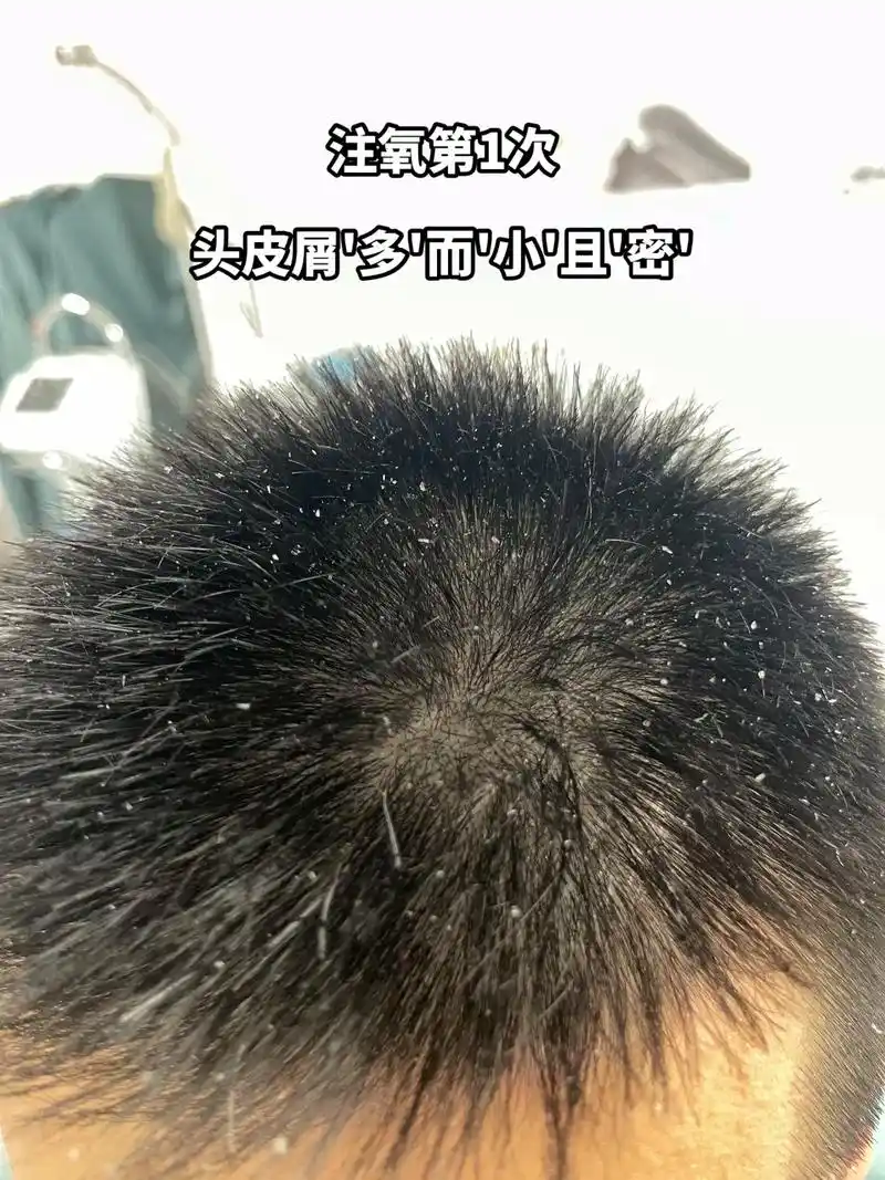 头皮屑 #头屑 #去屑止痒 #头皮护理  - 抖音
