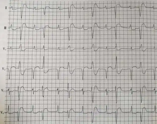 洋地黄中毒最常见的心脏表现为心律失常,主要为室性期前收缩,约占洋
