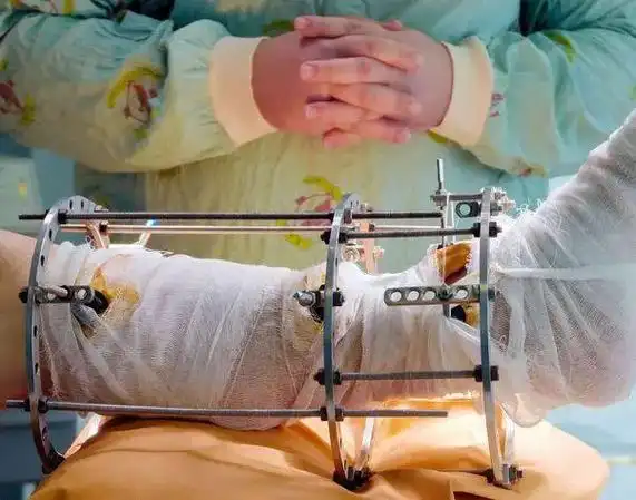 真相其实很残忍|手术|畸形|受术者|延长术|神经损伤|世界关节炎日