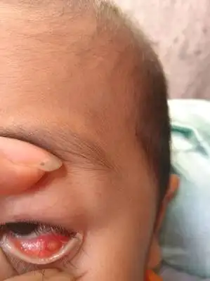 请问大家下,三岁小孩眼睛里肉长了一小粒黄色的,是怎麼怎会呢