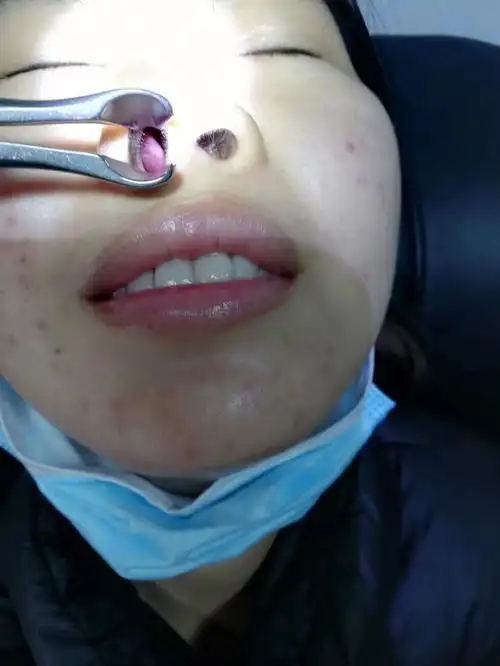 鼻甲肥大,过敏性鼻炎  上药了四次对比,不会堵塞,打喷涕了  还流点