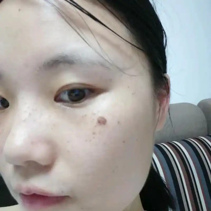 激光祛斑第五天,有两个斑点的结痂被我不小心揉掉了01今天终于可以