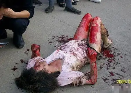 成都公交车自燃受伤女孩图片