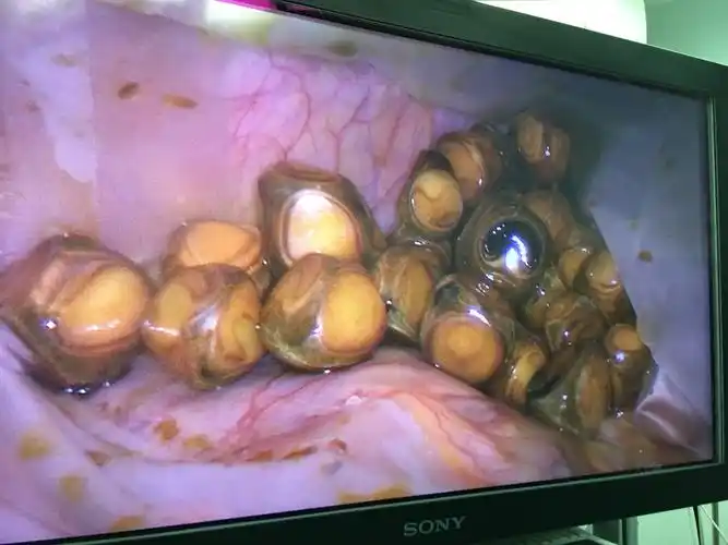 典型的胆囊结石 - 好大夫在线